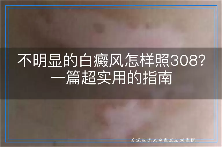 不明显的白癜风怎样照308？一篇超实用的指南