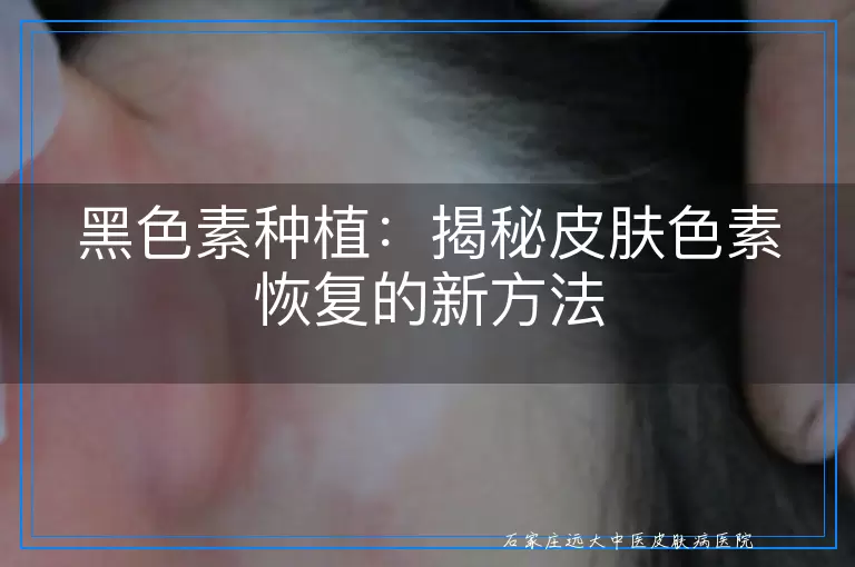 黑色素种植：揭秘皮肤色素恢复的新方法