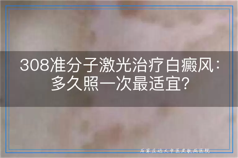 308准分子激光治疗白癜风：多久照一次最适宜？