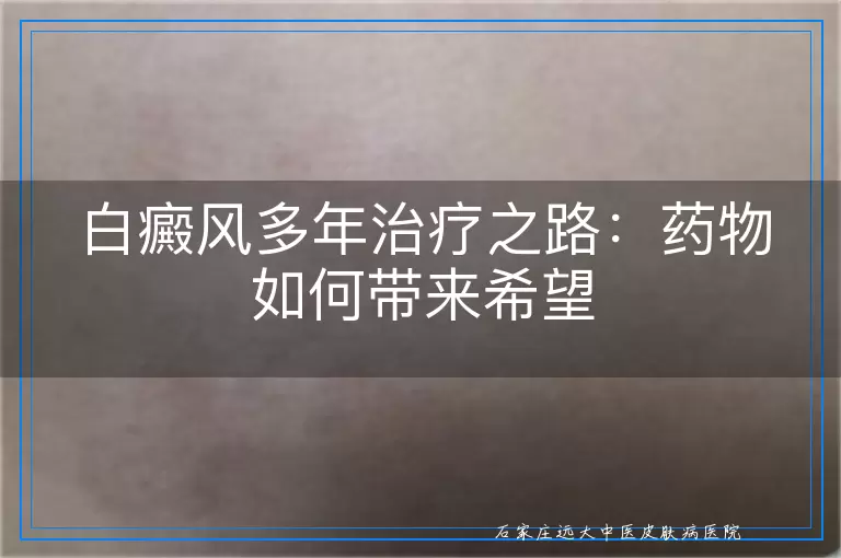白癜风多年治疗之路：药物如何带来希望