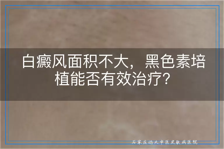 白癜风面积不大，黑色素培植能否有效治疗？
