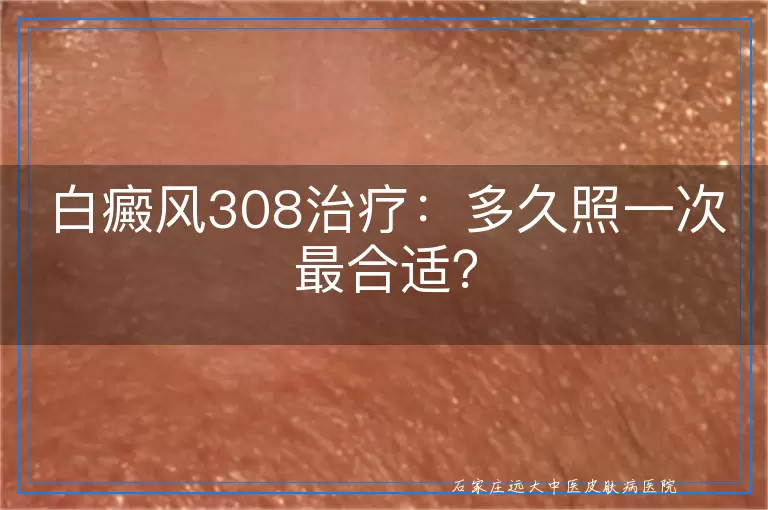 白癜风308治疗：多久照一次最合适？