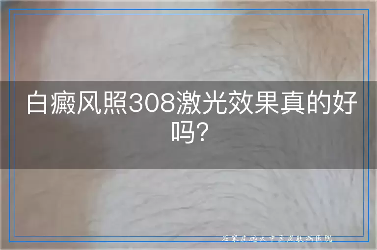 白癜风照308激光效果真的好吗？