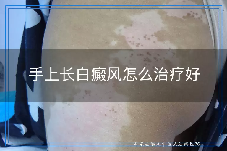 手上长白癜风怎么治疗好