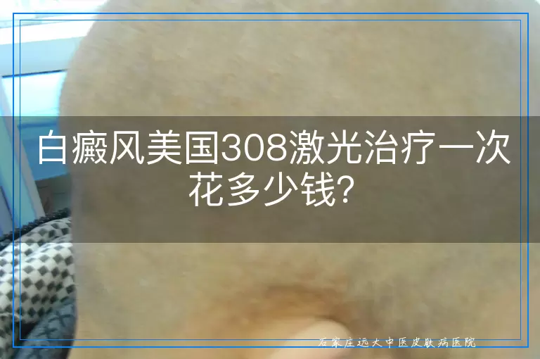 白癜风美国308激光治疗一次花多少钱？