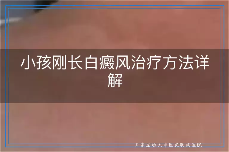 小孩刚长白癜风治疗方法详解