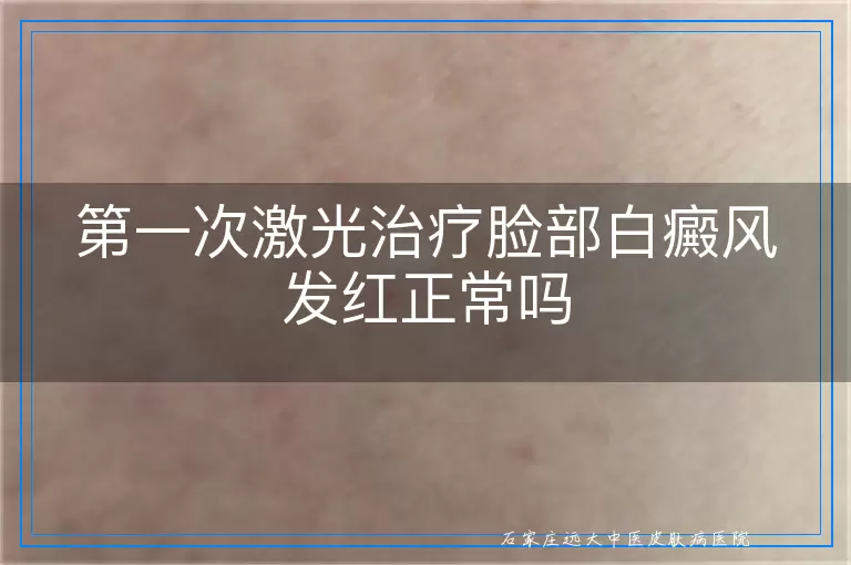 第一次激光治疗脸部白癜风发红正常吗
