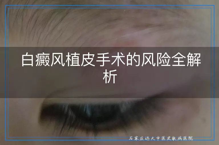 白癜风植皮手术的风险全解析