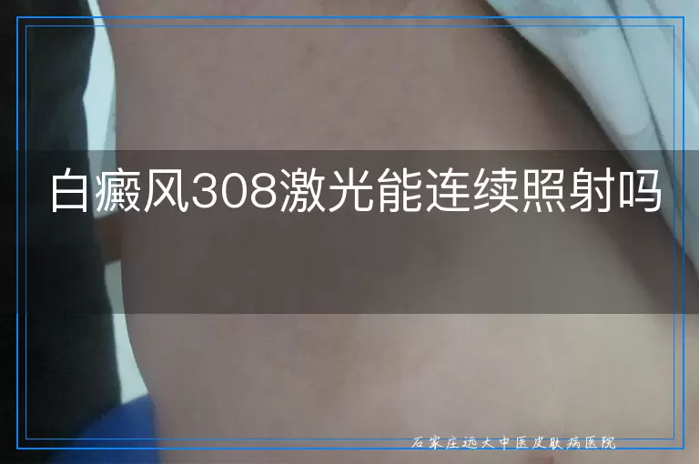 白癜风308激光能连续照射吗