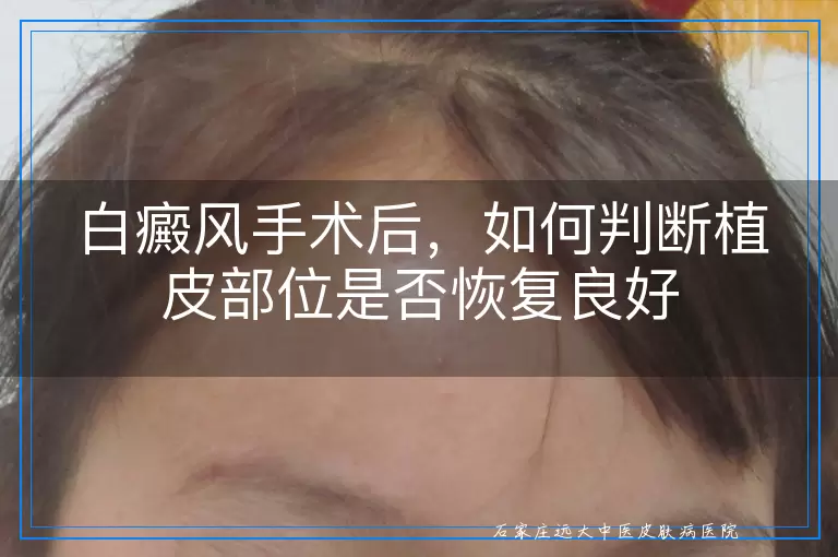 白癜风手术后，如何判断植皮部位是否恢复良好