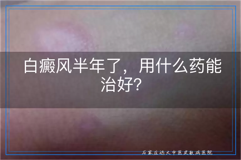 白癜风半年了，用什么药能治好？
