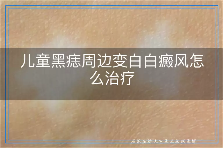 儿童黑痣周边变白白癜风怎么治疗