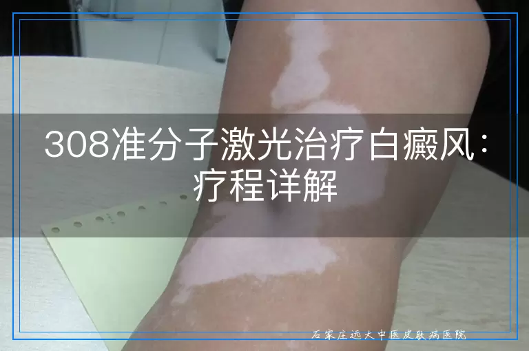 308准分子激光治疗白癜风：疗程详解