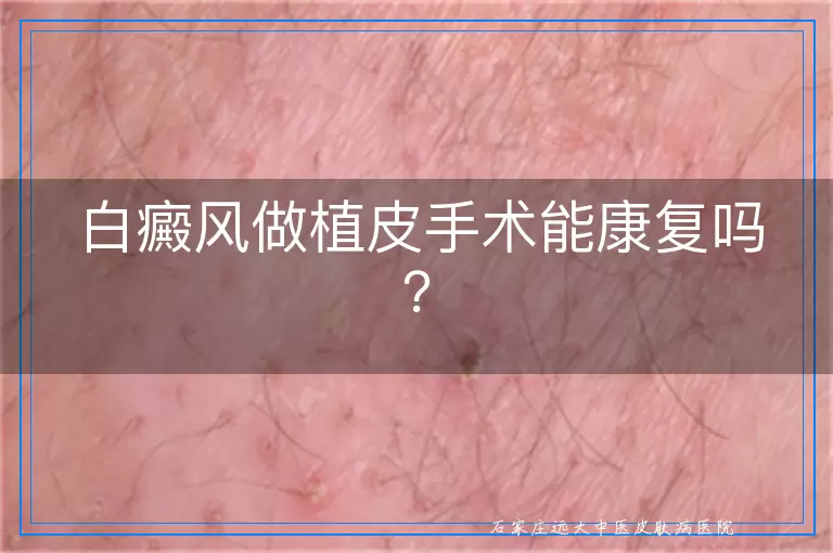 白癜风做植皮手术能康复吗？