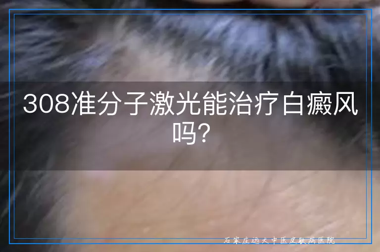 308准分子激光能治疗白癜风吗？