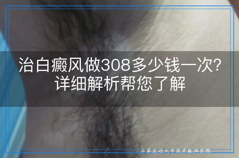 治白癜风做308多少钱一次？详细解析帮您了解