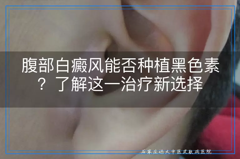 腹部白癜风能否种植黑色素？了解这一治疗新选择