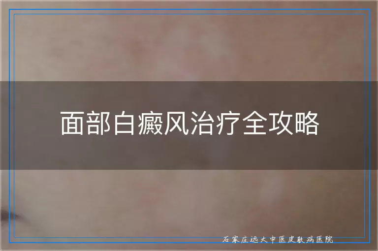 面部白癜风治疗全攻略