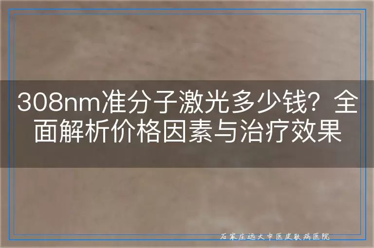 308nm准分子激光多少钱？全面解析价格因素与治疗效果