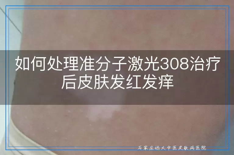 如何处理准分子激光308治疗后皮肤发红发痒