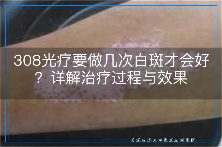 308光疗要做几次白斑才会好？详解治疗过程与效果