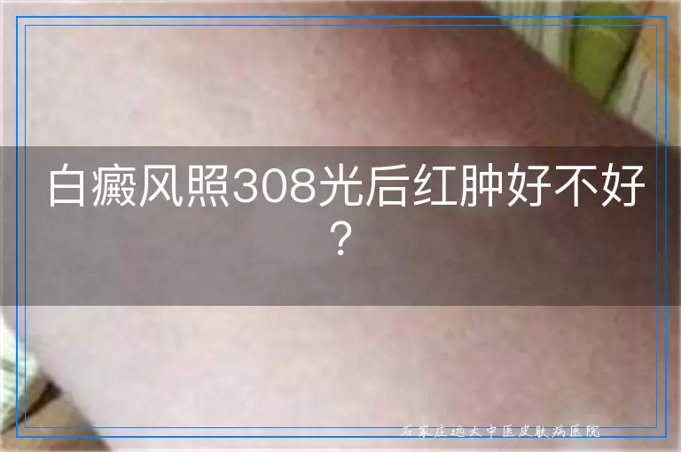 白癜风照308光后红肿好不好？