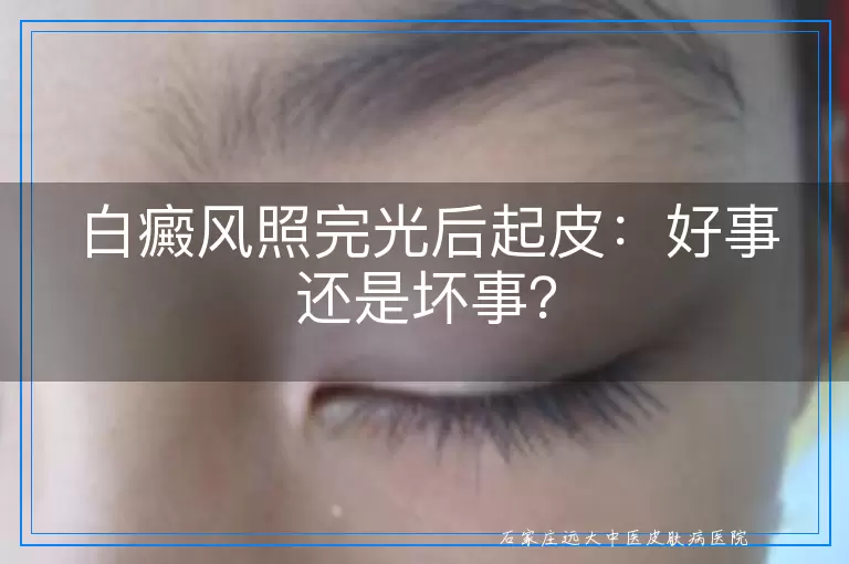 白癜风照完光后起皮：好事还是坏事？