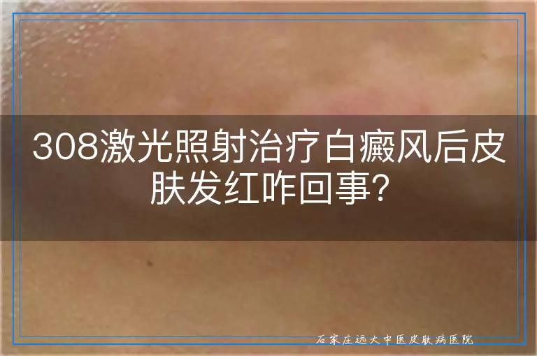 308激光照射治疗白癜风后皮肤发红咋回事？