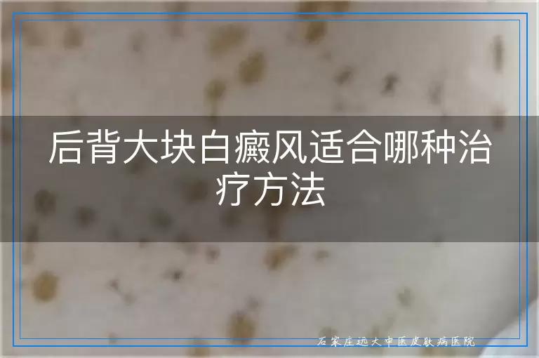 后背大块白癜风适合哪种治疗方法