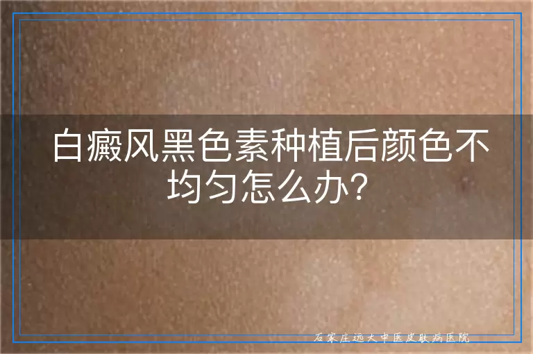 白癜风黑色素种植后颜色不均匀怎么办？