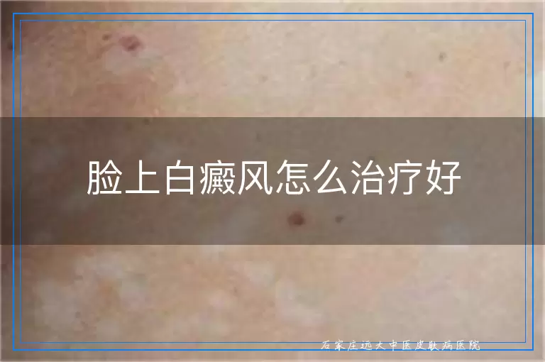 脸上白癜风怎么治疗好