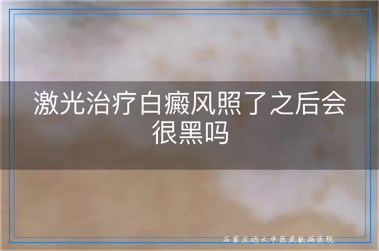 激光治疗白癜风照了之后会很黑吗