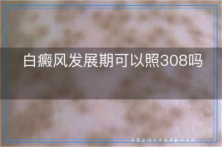 白癜风发展期可以照308吗