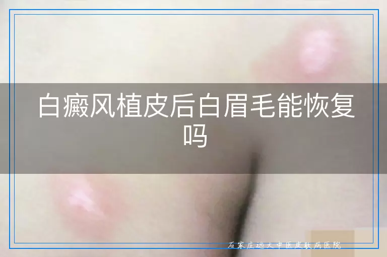 白癜风植皮后白眉毛能恢复吗