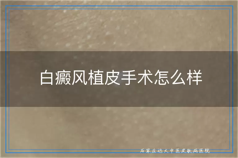 白癜风植皮手术怎么样