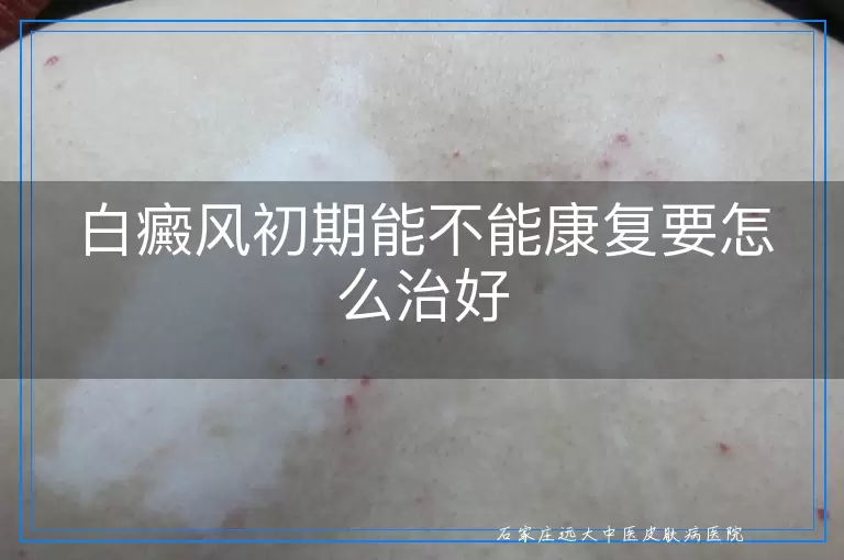 白癜风初期能不能康复要怎么治好