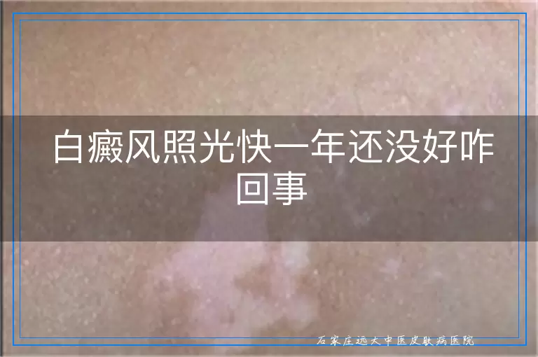 白癜风照光快一年还没好咋回事