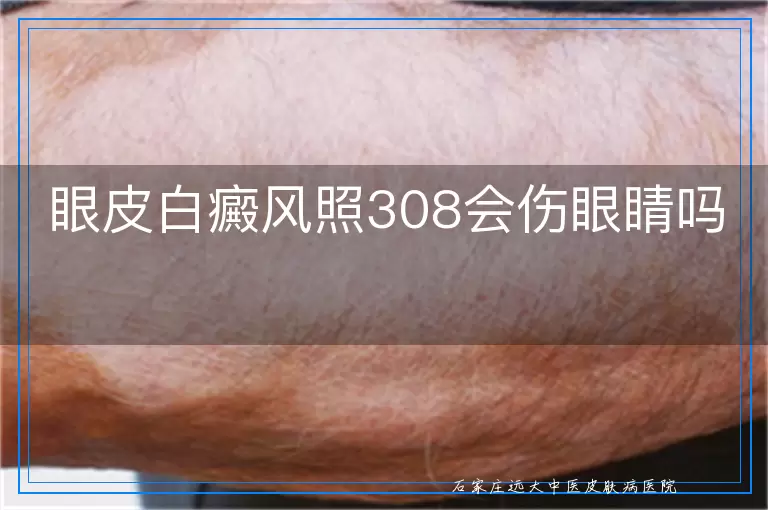眼皮白癜风照308会伤眼睛吗