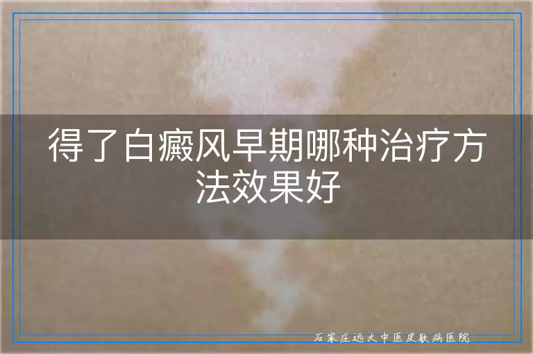 得了白癜风早期哪种治疗方法效果好
