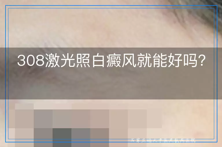 308激光照白癜风就能好吗？