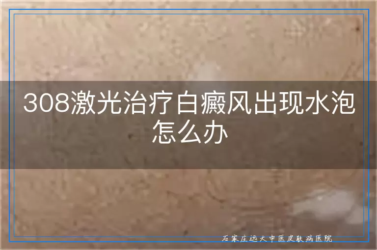 308激光治疗白癜风出现水泡怎么办