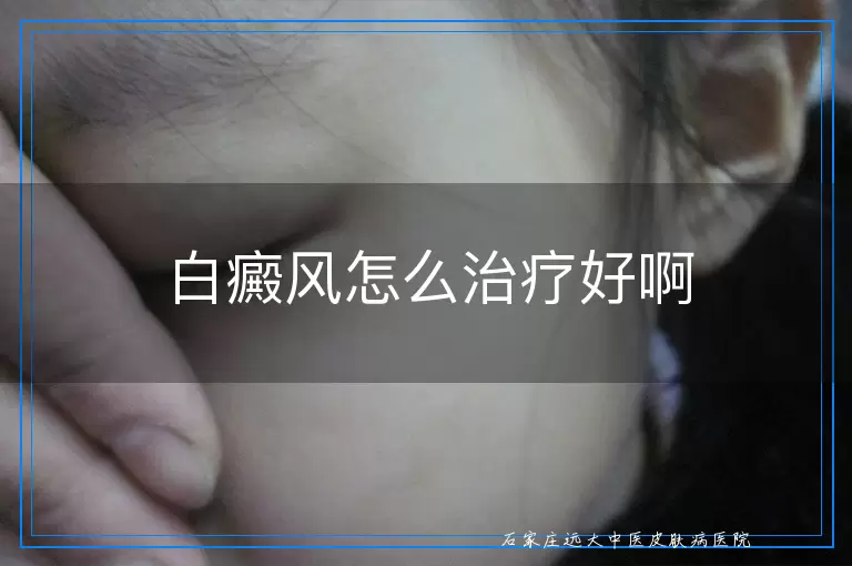 白癜风怎么治疗好啊
