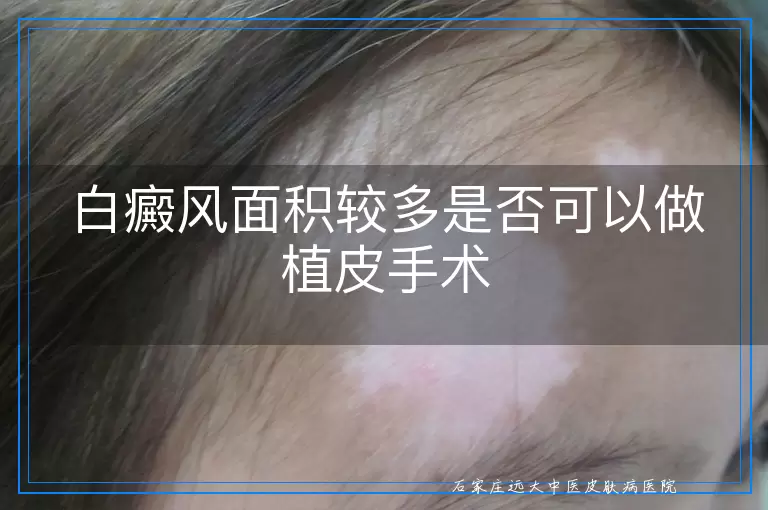 白癜风面积较多是否可以做植皮手术