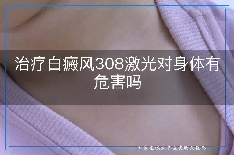 治疗白癜风308激光对身体有危害吗