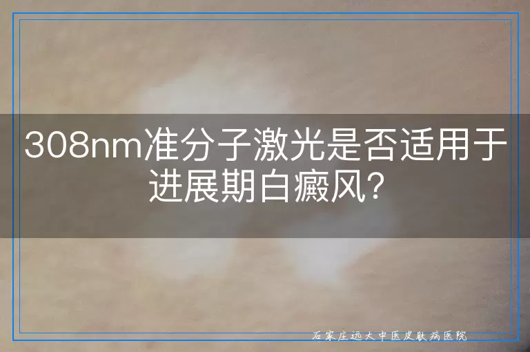 308nm准分子激光是否适用于进展期白癜风？