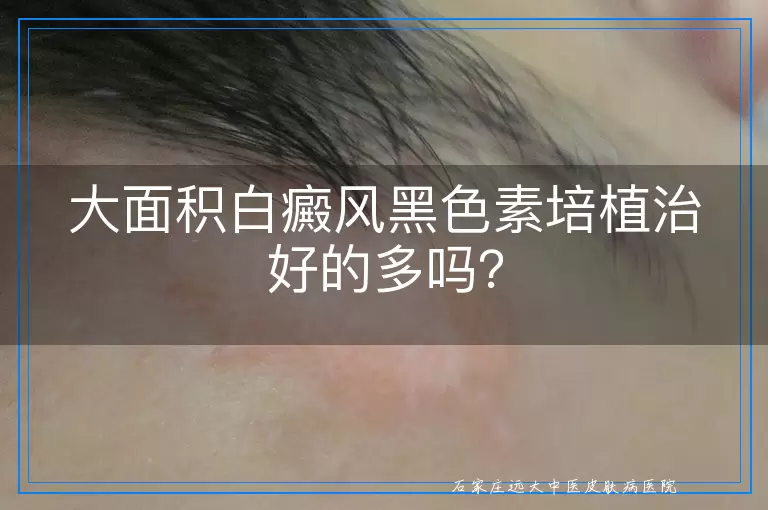 大面积白癜风黑色素培植治好的多吗？