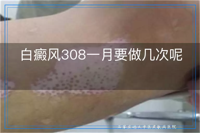 白癜风308一月要做几次呢