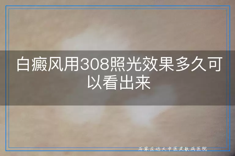 白癜风用308照光效果多久可以看出来