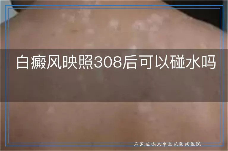 白癜风映照308后可以碰水吗