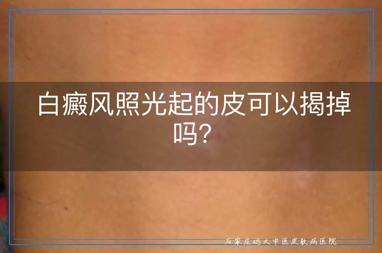 白癜风照光起的皮可以揭掉吗？